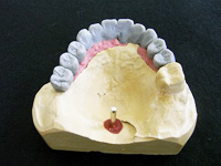 1.歯型の上に最終的な歯冠形態をワックスで再現します。